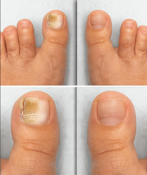 Fuggi mushroom - before and after treatment with fun cream