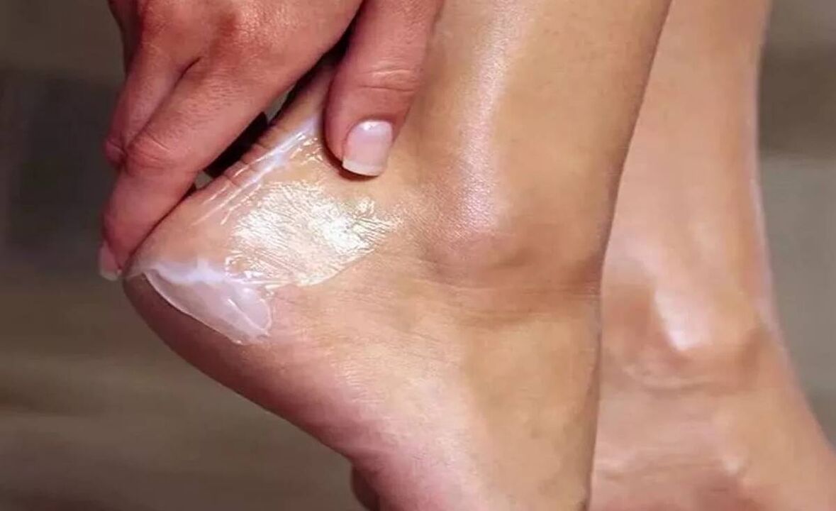 How to treat foot fungus with Fungent cream