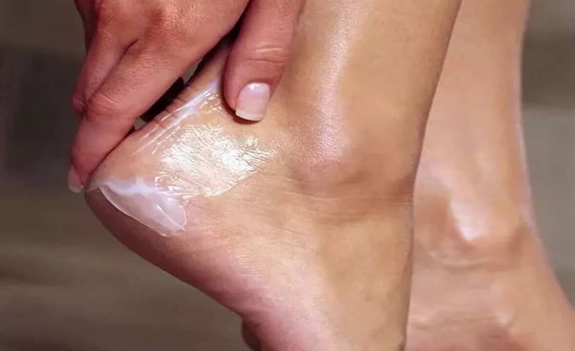 How to treat the foot mushroom with fun cream