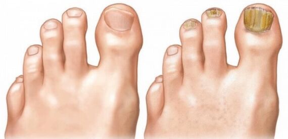 Normal and infected nails