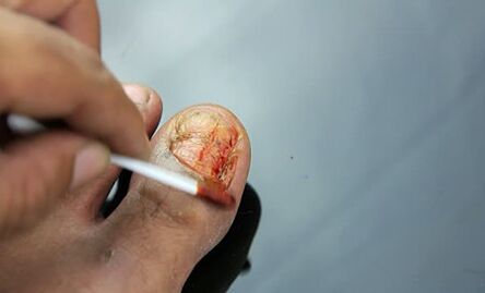 Treatment of injury with a fungus