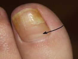 How to recognize the presence of a nail fungus on the thumb