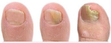 Stages of nail fungus development