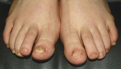 Signs and symptoms of fungi on the nails