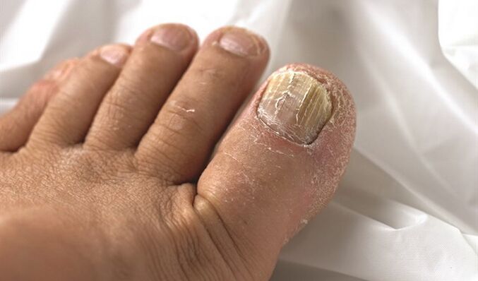 Extend the mycose lesion to the nail plate