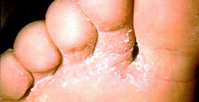 Skin fungus injury between fingers