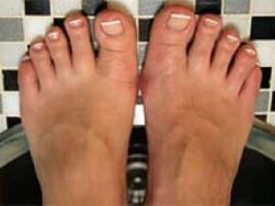 Nail fungus and leg skin