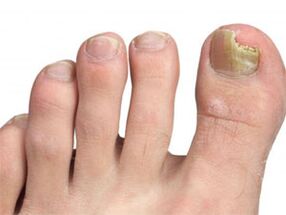 yellow spots on the fungus feet signal