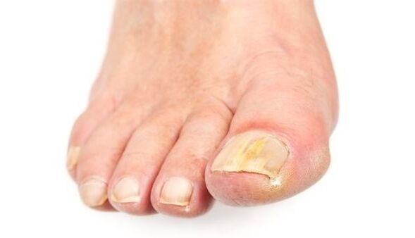 yellowing of the nail due to a fungal infection