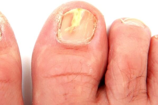 damage to the nail plate due to a fungal infection