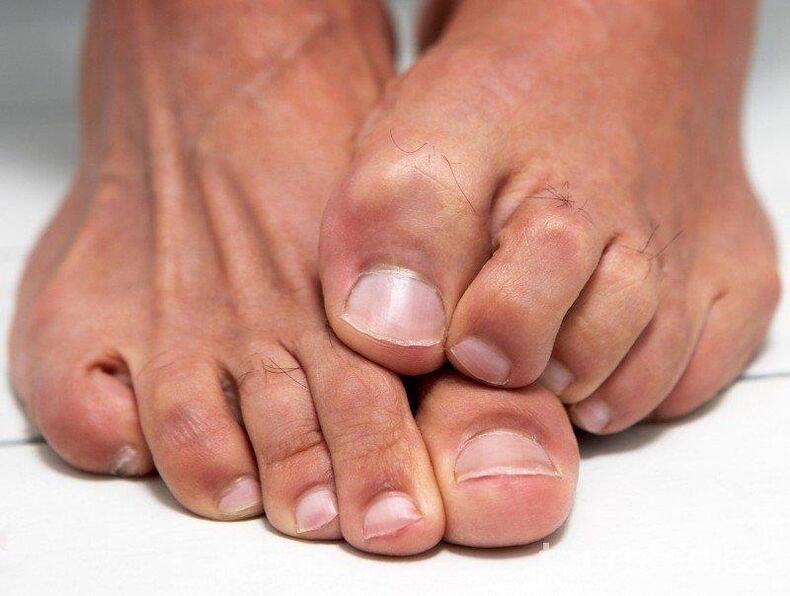 Toe fungus