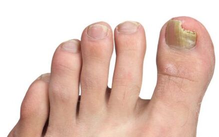 Fungus on the nail of the big toe.