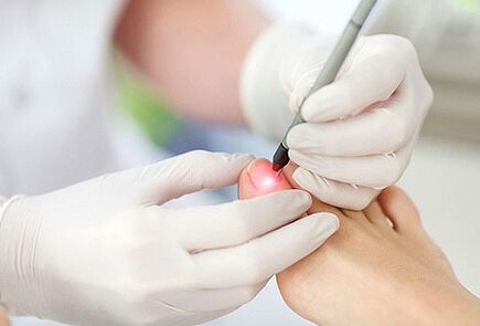 Laser treatment for toenail fungus.