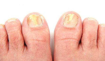 Manifestations of toenail fungus.