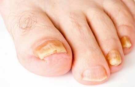 Yellowing of toenails due to fungus.
