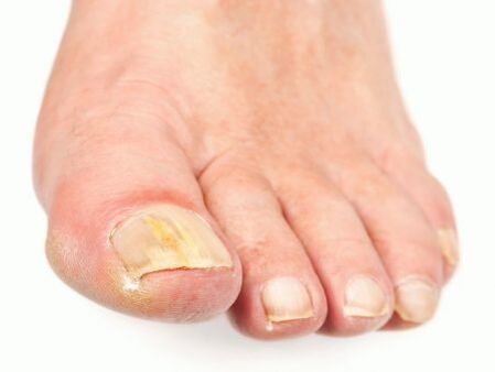 nail fungus damage