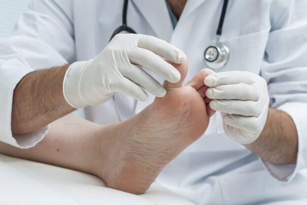 diagnosis of foot fungus by a doctor