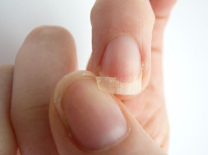 Nail detachment due to fungus.