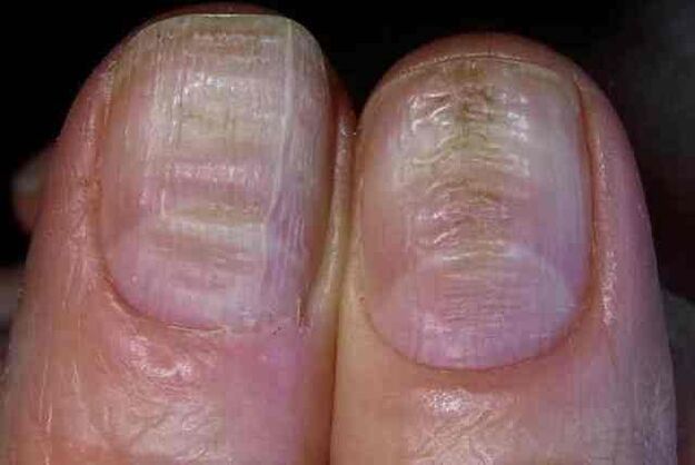 fungal infection of the nail plate