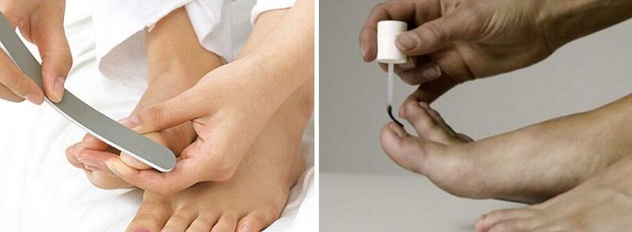 toenail fungus treatment with varnish