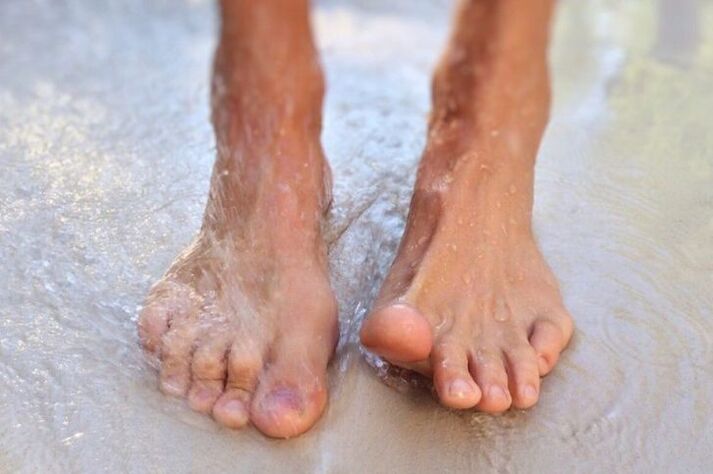 Walking barefoot as a way to get nail fungus